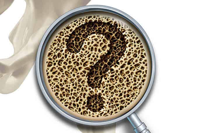 Bone Medical Questions